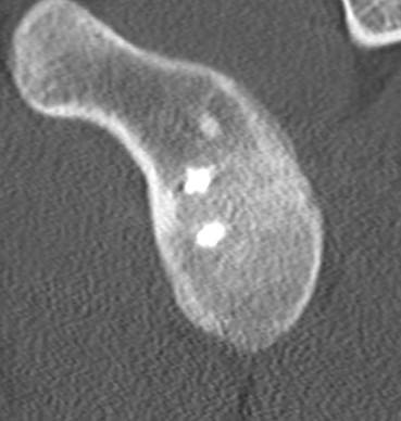 Failed Open Stabilisation CT Sagittal